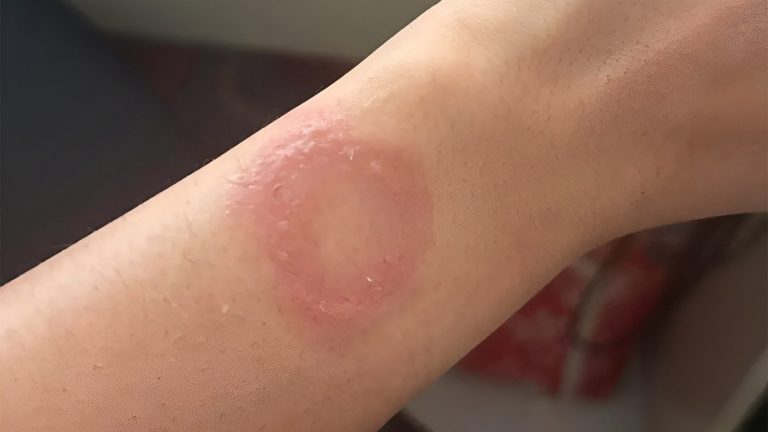 Apple Watch Caused A Wrist Burn, Claims Owner, But What Was More Agonizing Were His Complaints Falling On Deaf Ears; No Resolution Reached In 6 Months