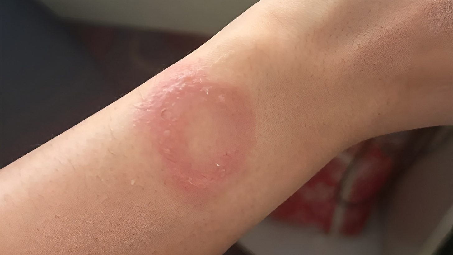 Apple Watch Caused A Wrist Burn, Claims Owner, But What Was More Agonizing Were His Complaints Falling On Deaf Ears; No Resolution Reached In 6 Months